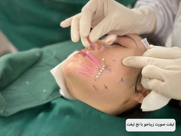پزشکی در حال استفاده از نخ لیفت روی صورت یک خانم جوان برای لیفت صورت او هست.