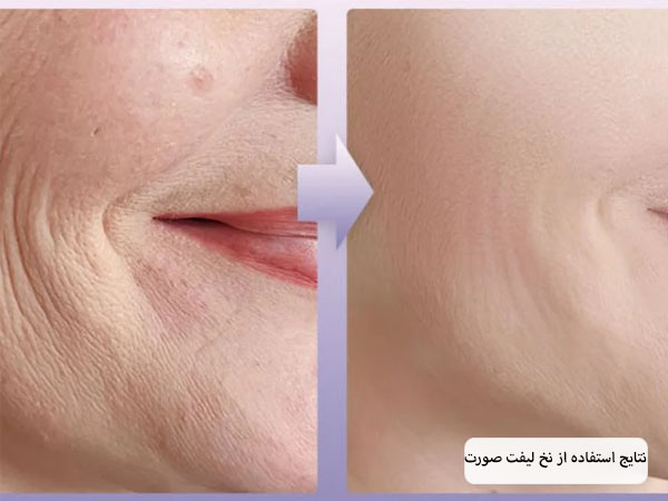 صورت یک خانم قبل و بعد از استفاده از نخ لیفت که خط خنده های صورتش کاملا رفع شده اند.