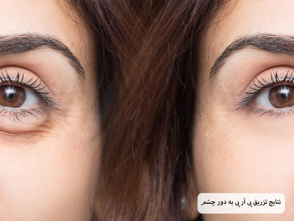 پوست دور چشم یک خانم قبل و بعد از تزریق پی آر پی که بهبود بسیار چشم گیری داشته است.