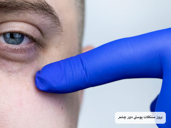 مشکل پوستی دوش چشم یک آقای جوان در پس زمینه سفید.