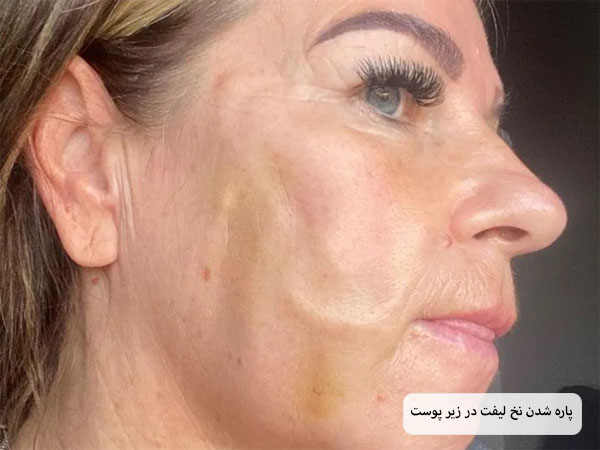 نمای نیم رخ یک خانم که نخ لیفت مورد استفاده در صورت وی پاره شده است و قسمتی از صورت کبود شده است.