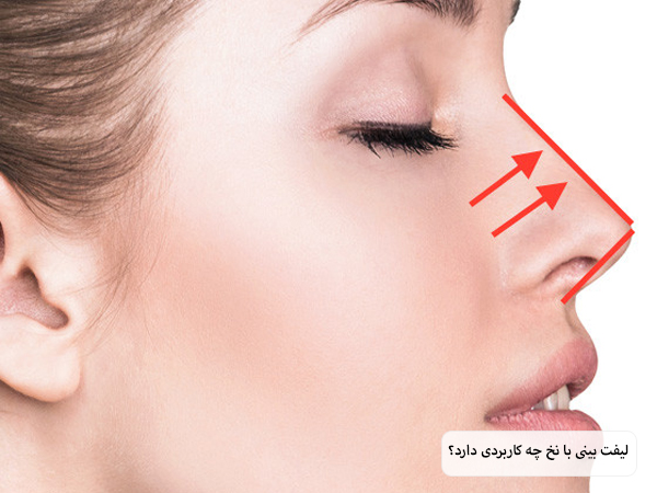 نشان دادن تاثیر استفاده از نخ لیفت با چند فلش و خطوط قرمز رنگ فرضی روی بینی یک خانم جوان با پس زمینه سفید.