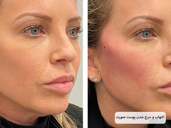 صورت یک خانم که در اثر پاره شدن نخ لیفت صورت دچار سرخی و التهاب شده است.