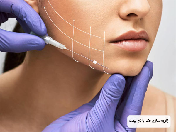 نقاط مخصوص استفاده از نخ برای لیفت روی صورت یک خانم جوان با خطوط سفید و مشکی رنگ نمایش داده شده است در پس زمینه سفید.