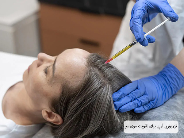 پزشکی در حال تزریق سرنگ حاوی پی آر پی به مو های سر یک خانم میانسال است.
