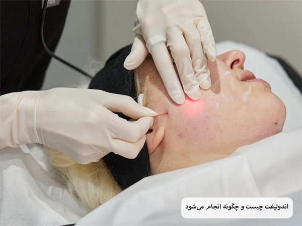 پزشکی در حال انجام عمل اندولیفت روی صورت یک خانم جوان.