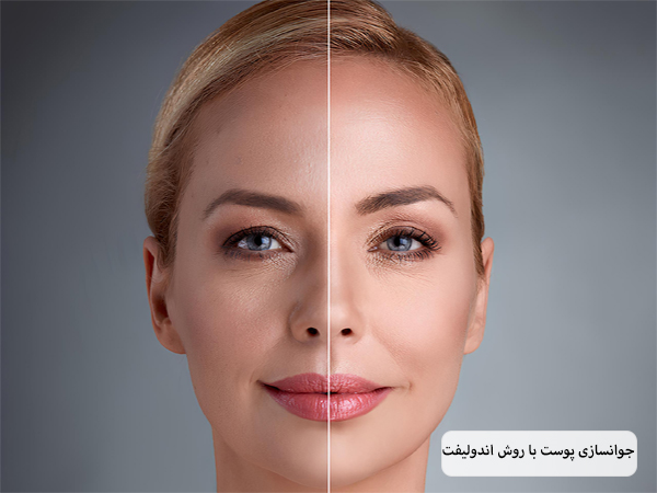 صورت یک خانم جوان قبل و بعد از استفاده از روش اندولیفت که پوستش روشن تر شده است.