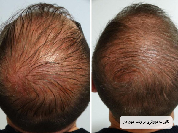 عکس سر یک آقا قبل و بعد از انجام مزوتراپی که رشد مو هایش افزایش چشم گیری داشته است.
