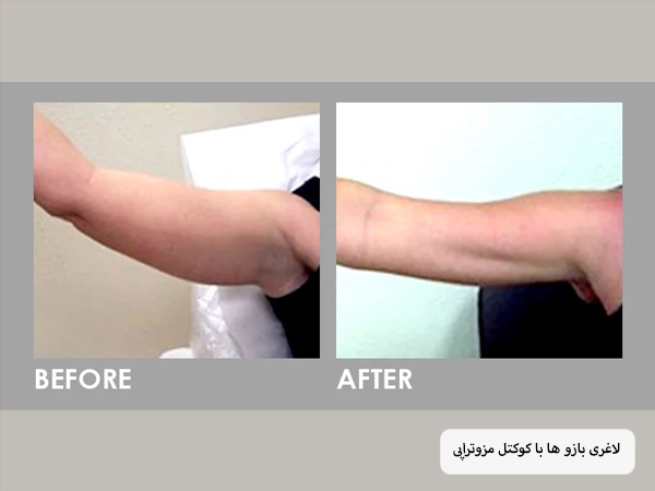 تصویر بازو های یک شخص قبل و بعد از انجام مزوتراپی که لاغری چشم گیری داشته است.