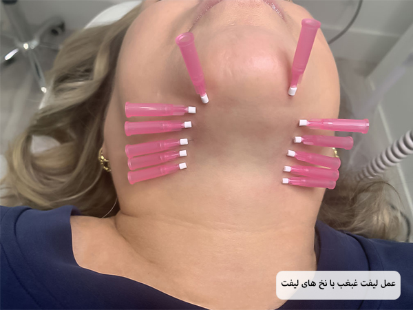 صورت یک خانم جوان از نمای نیم رخ قبل و بعد از لیفت غبغب با نخ که تغییر زیادی کرده است با پس زمینه سفید.