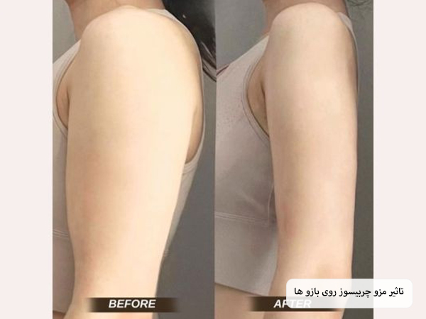 نواحی مختلف روی شکم یک خانم که برای تزریق کوکتل چربی سوز مشخص شده اند در پس زمینه سفید.