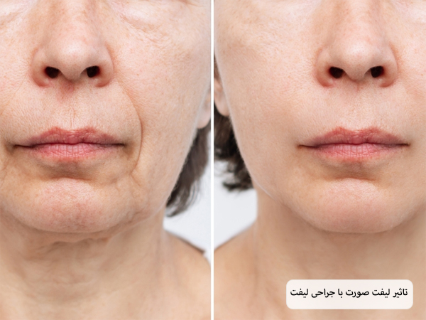 صورت یک خانم قبل و بعد از انجام جراحی لیفت.