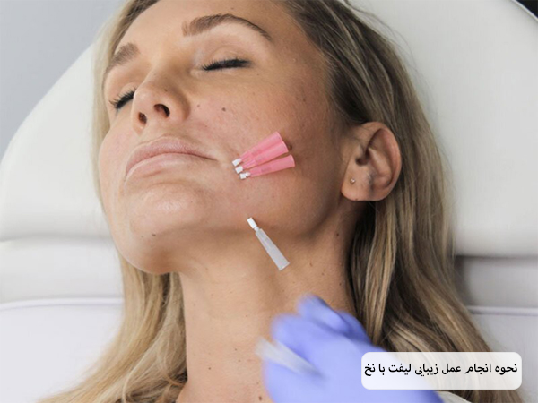 چند عدد نخ لیفت که در قسمت های مختلف صورت یک خانم قرار گرفته اند.