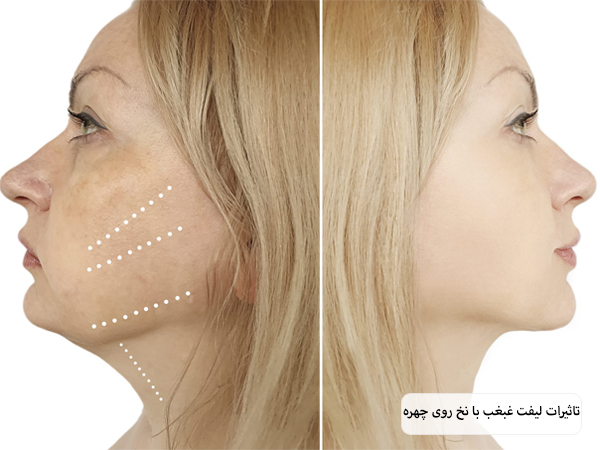 صورت یک خانم جوان از نمای نیم رخ قبل و بعد از لیفت غبغب با نخ که تغییر زیادی کرده است با پس زمینه سفید.