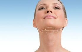 نقاط مخصوص لیفت غبغب با نخ که با خطوط فرضی روی ناحیه غبغب یک خانم نمایش داده شده اند با پس زمینه آبی سفید.