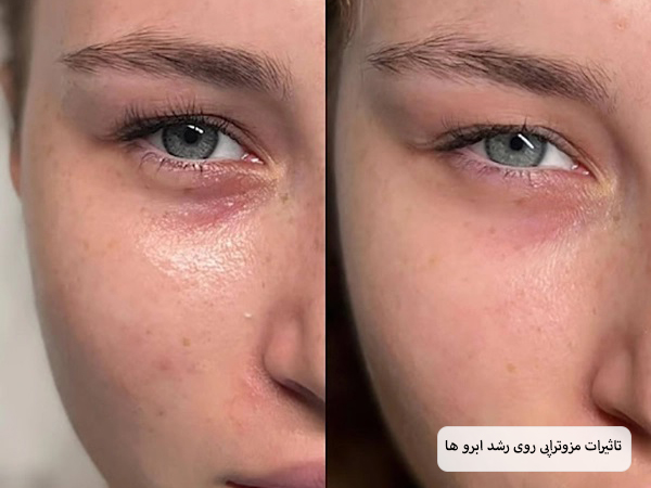 ابرو های یک خانم جوان قبل و بعد از انجام مزوتراپی