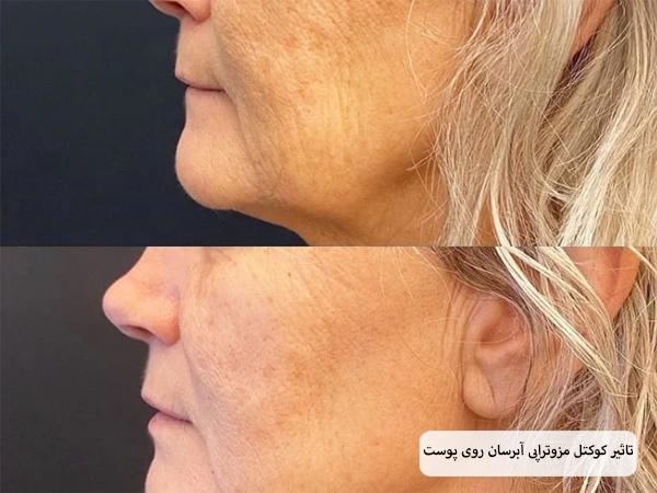 صورت یک خانم قبل و بعد از انجام مزوتراپی با هیالورونیک اسید.