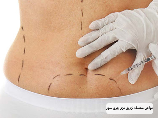 نواحی مختلف روی شکم یک خانم که برای تزریق کوکتل چربی سوز مشخص شده اند در پس زمینه سفید.