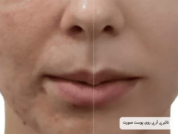 صورت یک خانم قبل و بعد از انجام پی آر پی صورت.