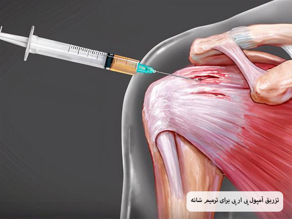 تزریق محلول پی آر پی به شانه های یک شخص توسط پزشک.