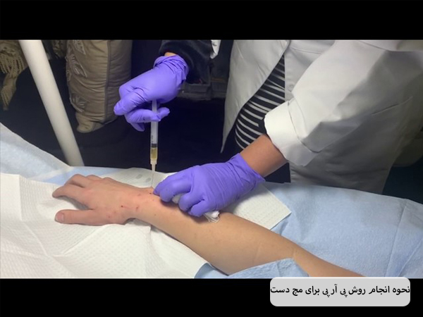 پزشکی در حال تزریق سرنگ حاوی پی آر پی به مچ دست یک شخص.