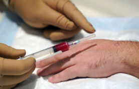 پی آر پی درمانی مچ دست یک آقا.