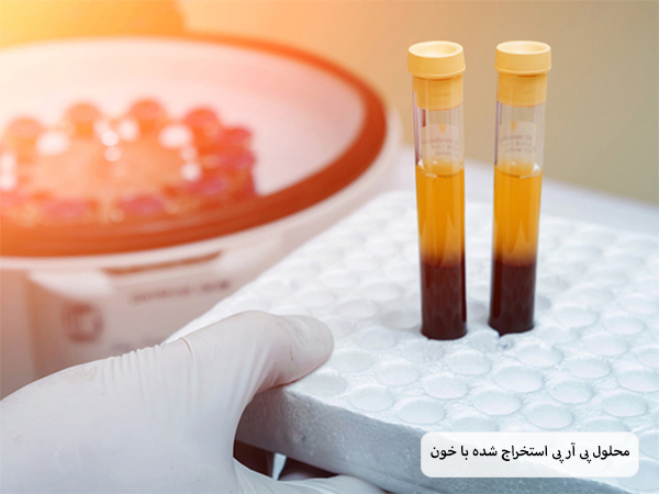 چند عدد شیشه حاوی مجلول پی آر پی و خون در دستگاه یک پزشک یا اپراتور.