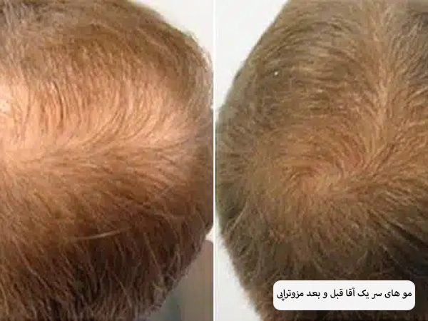 عکس قبل و بعد مزوتراپی موی سر.