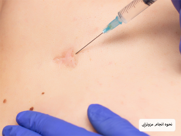 تزریق کوکتل مزوتراپی به آسکار پوست توسط پزشک.