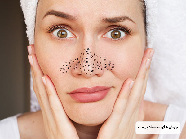 خانمی که نقشی از جوش های سرسیاه روی پوست خود ایجاد نموده است.