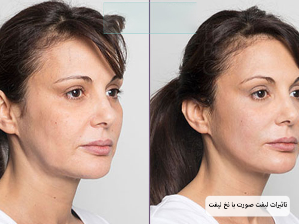 صورت یک خانم قبل و بعد از انجام لیفت با نخ که بهبود چشم گیری داشته است.