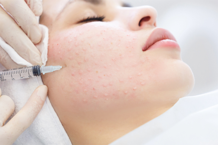 پزشکی در حال مزوتراپی روی صورت یک زیباجوی جوان است.