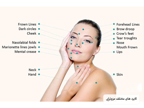 نقاط مخصوص انجام مزوتراپی که روی تصویر یک خانم جوان نوشته شذه است با پس زمینه استخوانی رنگ.