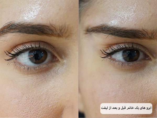 ابرو های یک خانم قبل و بعد از استفاده از نخ لیفت که بهبود چشم گیری داشته.