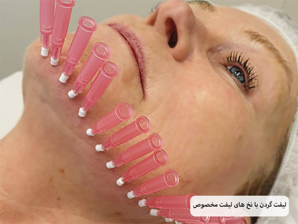 انجام عمل لیفت با نخ روی گردن یک خانم زیبا جو.