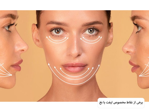 نقاط مناسب لیفت با نخ که روی صورت یک خانم از سه زاویه متفاوت با خطوط فرضی نشان داده شده اند.