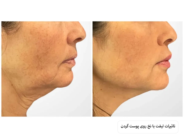 پوست گردن یک خانم قبل و بعد از لیفت با نخ.