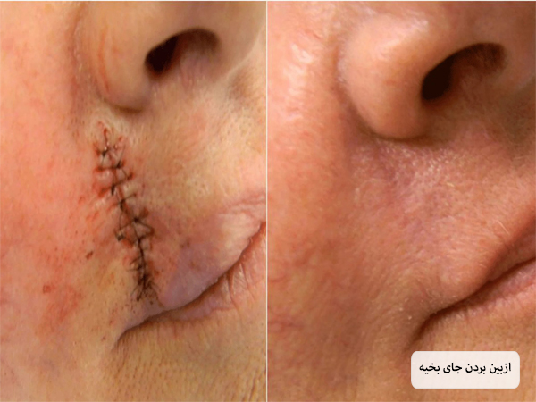 محو شدن جای بخیه روی صورت با مزوتراپی.