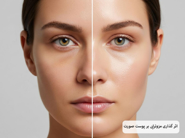 صورت یک خانم که به دو نیمه تقسیم شده تا اثر مزوتراپی را قبل و بعد از انجامش نشان دهد.