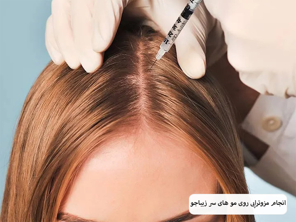 پزشک در حال تزریق کوکتل مزوتراپی به سر یک خانم جوان است.