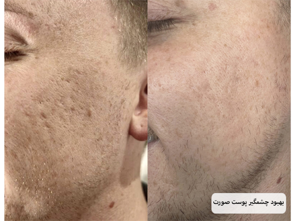 پوست صورت یک آقا قبل و بعد از انجام مزوتراپی که بهبودی چشم گیری داشته است.