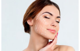 صورت یک خانم جوان که نقاط مخصوص لیفت با نخ روی صورتش با خطوط فرضی سفید رنگ نمایش داده شده است.