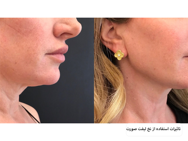 صورت یک خانم بعد از لیفت پوست با نخ که هیچ گونه اثری از نخ باقی نمانده است.