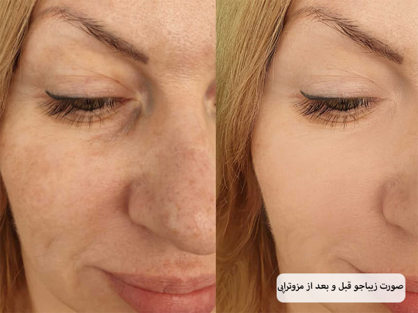 صورت یک خانم زیبا جو قبل و بعد از انجام مزوتراپی.