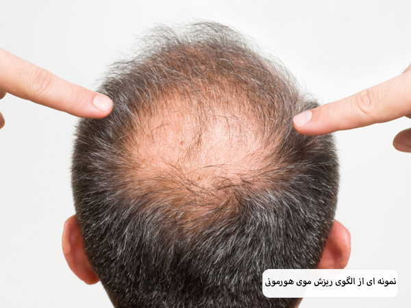 سر طاس یک اقا از نمای پشت که دچار ریزش موی هورمونی شده است و دو انگشت از دو طرف سر در حال اشاره به او هستند با پس زمینه سفید.