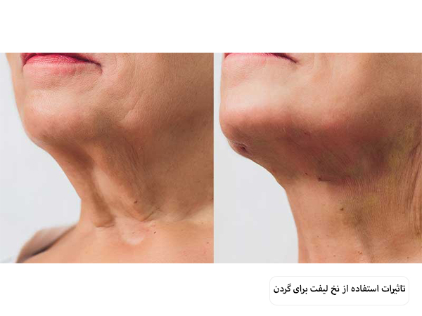 پوست گردن یک خانم قبل و بعد از لیفت با نخ.
