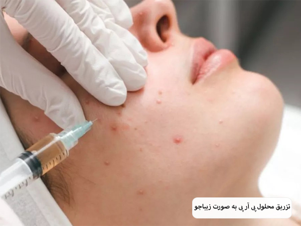 انجام عمل پی آر پی روی صورت یک خانم جوان.