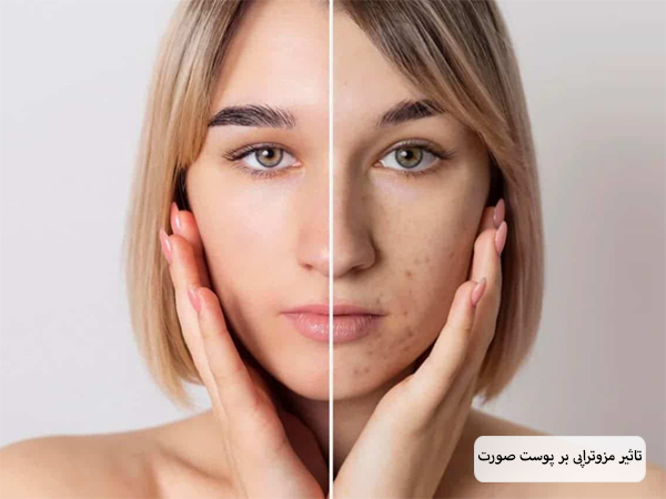 پوست صورت یک خانم جوان قبل و بعد از انجام مزوتراپی.