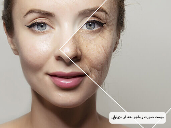 صورت یک خانم قبل و بعد از انجام مزوتراپی صورت.