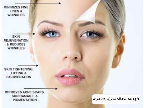 کاربرد های مختلف مزوتراپی روی صورت یک خانم نمایش داده شده است با پس زمینه آبی روشن.